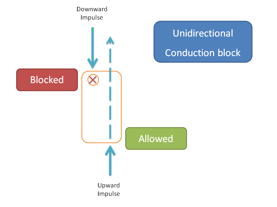 Unidirectional block in cardiac conduction pathways leading to re-entry type of arrhythmia